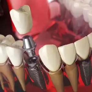 How Dental Implants in Raleigh Enhance Oral Health