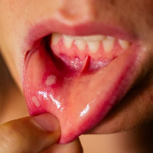Close up of a woman showing off a canker sore on her inner lip