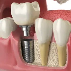 Top 5 Recovery Tips for Dental Implants in Raleigh