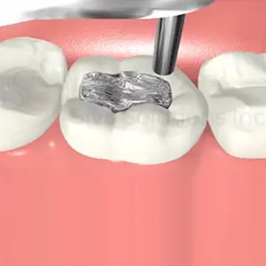 Three teeth are shown, each with a different material for dental fillings