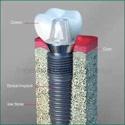 Diagram of a dental implant used for dental implants in Cary and Raleigh NC