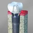 A dental implant, one of the Smiles of Cary dental specialties